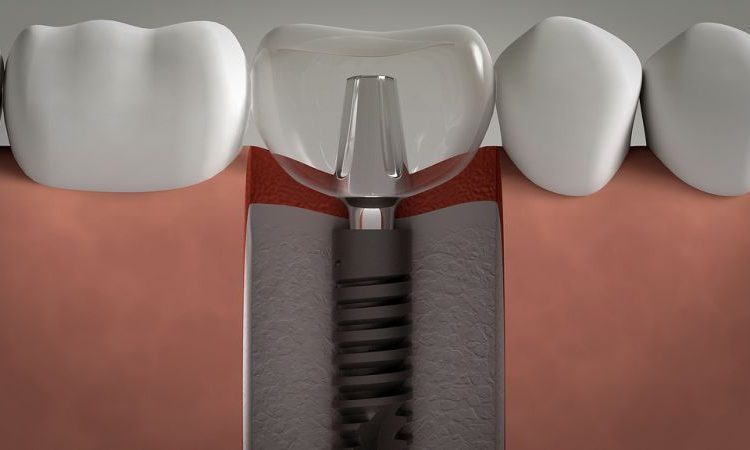 Implant dentaire d'un jour ou immédiat | Le meilleur implant à Ispahan