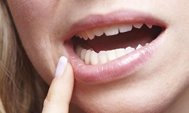 بررسی انواع کیست دندان و دهان | Le meilleur dentiste d'Ispahan