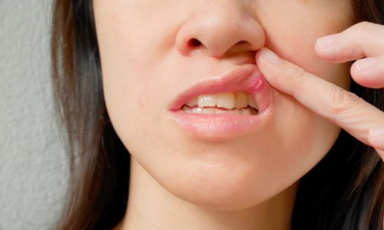 Investigating the causes of canker sores | The best gum surgeon in Isfahan