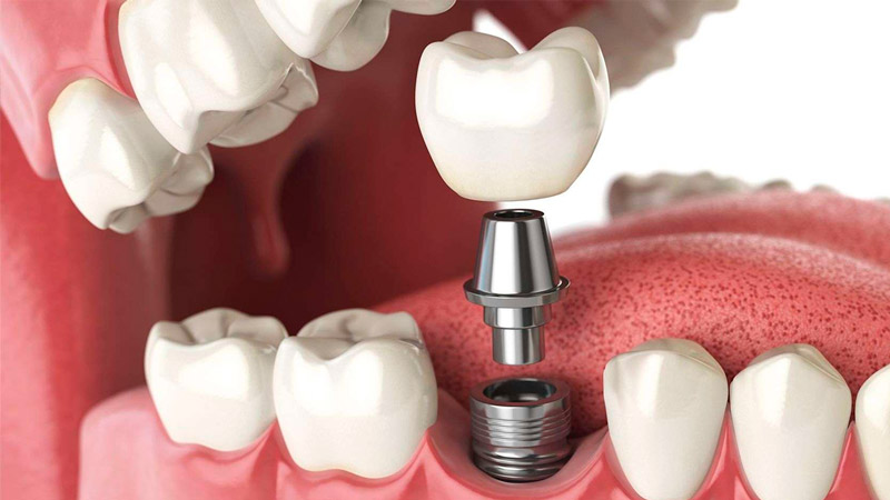 بررسی مراحل ایمپلنت دندان | بهترین ایمپلنت اصفهان