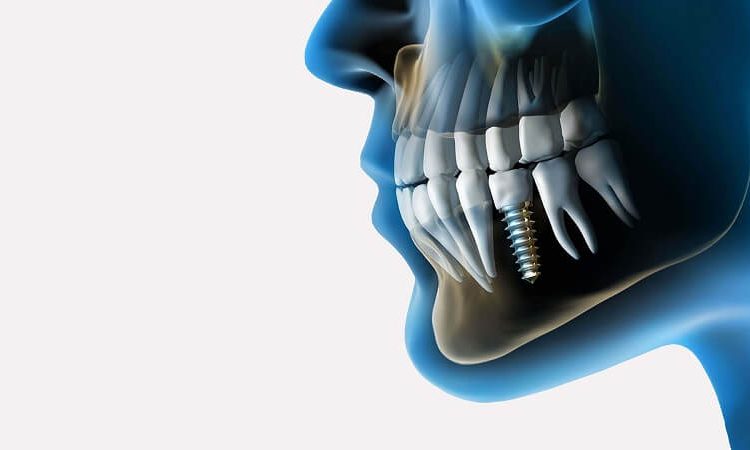 Examining dental implant procedures | The best implant in Isfahan