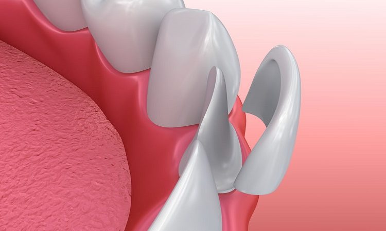 روش مراقبت از دندان شیری روکش شده | بهترین دندانپزشک اصفهان