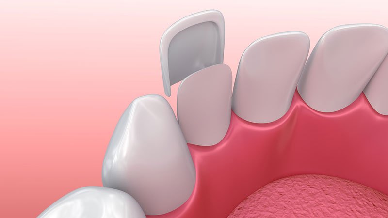 روش مراقبت از دندان شیری روکش شده | بهترین دندانپزشک اصفهان