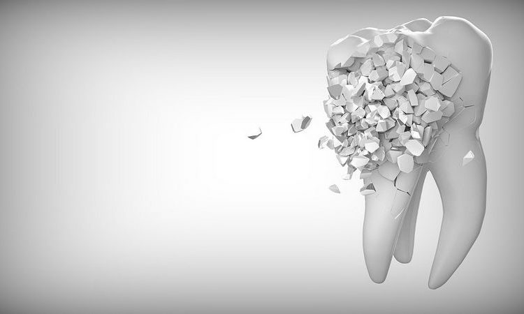 Quelles sont les méthodes de renforcement de l'émail des dents ? | Le meilleur dentiste cosmétique à Ispahan
