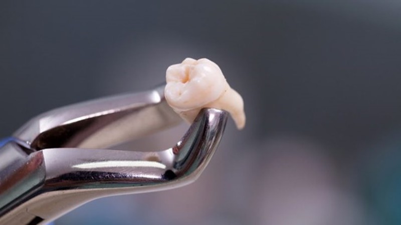 سن مناسب کشیدن دندان عقل چه زمانی است؟ | بهترین ایمپلنت اصفهان