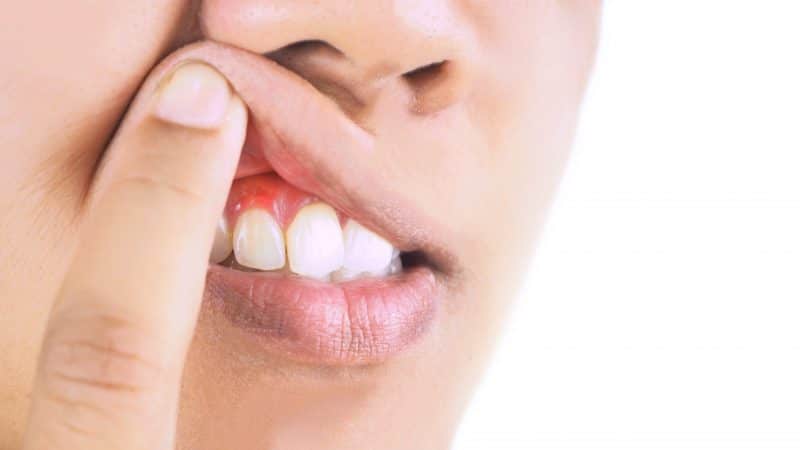 What are the causes of gum disease? | The best gum surgeon in Isfahan