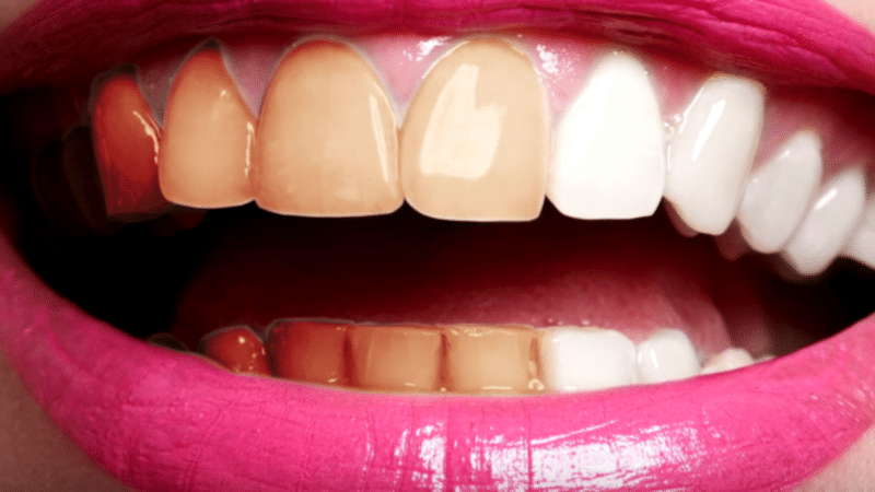 علل تغییر رنگ دندانها بعد از عصب کشی چیست؟ | بهترین دندانپزشک زیبایی اصفهان