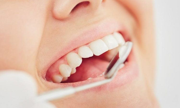 Causes and treatment of tooth enamel erosion | The best cosmetic dentist in Isfahan