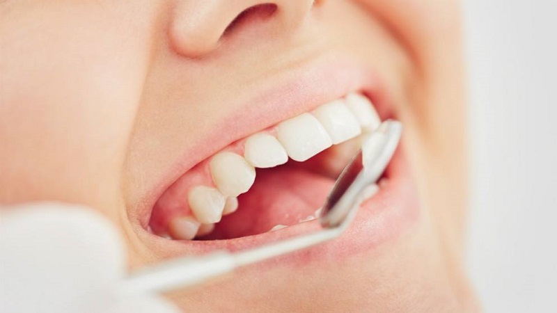 Causes et traitement de l'érosion de l'émail dentaire | Le meilleur dentiste cosmétique à Ispahan