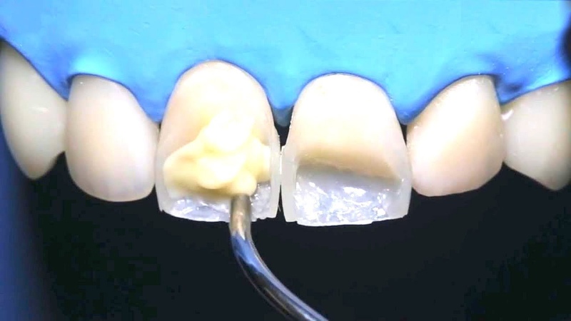 Causes et traitement de l'érosion de l'émail dentaire | Le meilleur dentiste cosmétique à Ispahan