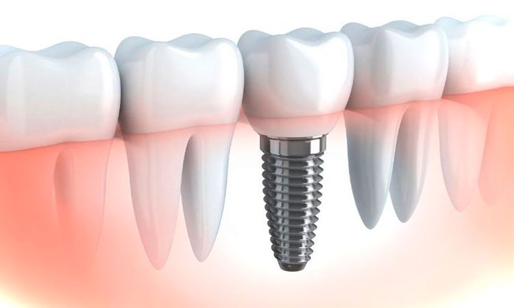 عوارض ایمپلنت دندان چیست؟ | بهترین ایمپلنت اصفهان