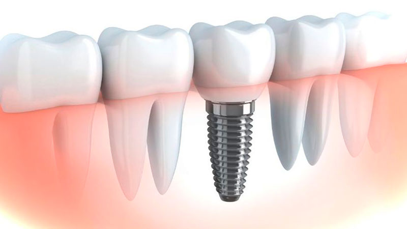عوارض ایمپلنت دندان چیست؟ | Le meilleur implant à Ispahan