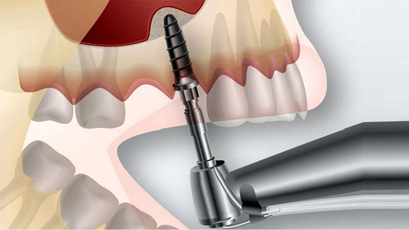 عوارض ایمپلنت دندان چیست؟ | بهترین ایمپلنت اصفهان