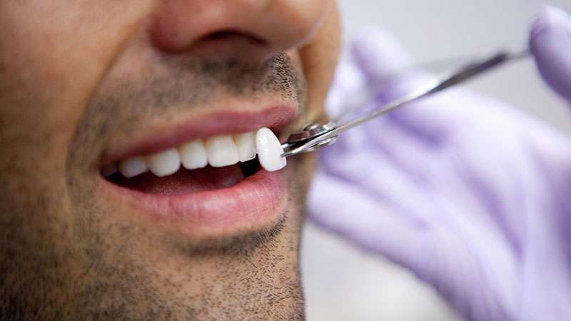 عوارض لمینت کردن دندان چیست؟ | بهترین دندانپزشک زیبایی اصفهان