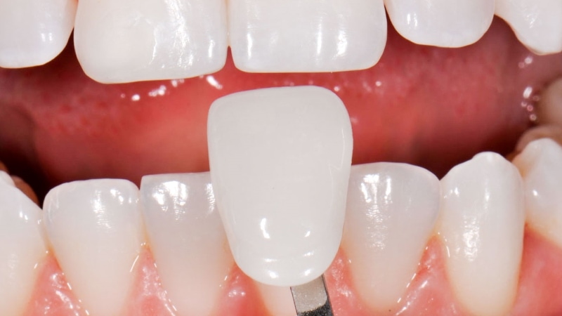 لمینت دندان برای چه افرادی مناسب است؟ | بهترین دندانپزشک اصفهان
