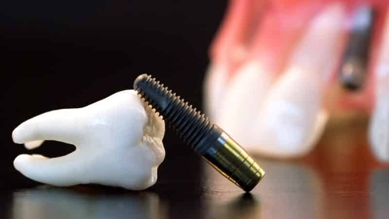مواردی که استفاده از ایمپلنت دندان منع شده است | بهترین دندانپزشک زیبایی اصفهان
