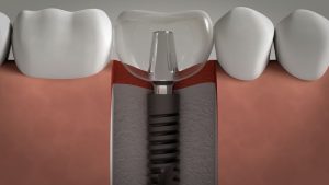 Dans quelle mesure les implants dentaires sont-ils sûrs et durables ? | Le meilleur implant à Ispahan