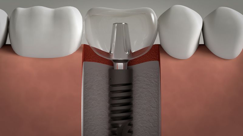 میزان ایمنی و دوام ایمپلنت های دندان چقدر است؟ | بهترین ایمپلنت اصفهان