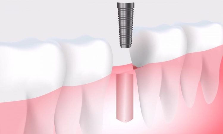 How safe and durable are dental implants? | The best implant in Isfahan