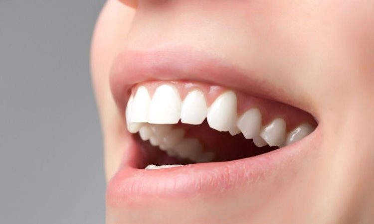 نحوه ترمیم لمینت دندان | بهترین دندانپزشک اصفهان