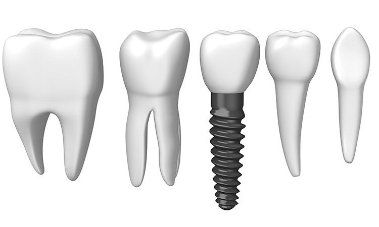 پاسخ به پرسش های رایج ایمپلنت دندان | La première partie | Le meilleur dentiste d'Ispahan