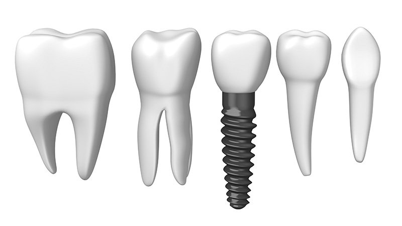 پاسخ به پرسش های رایج ایمپلنت دندان | بخش اول | بهترین دندانپزشک اصفهان