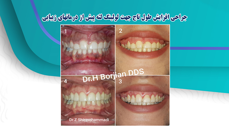 Crown lengthening surgery for gum leveling before cosmetic treatments | The best gum surgeon in Isfahan