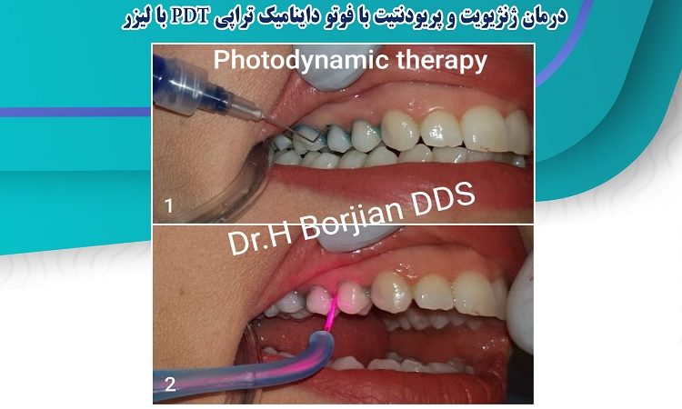 Treatment of gingivitis and periodontitis with PDT photodynamic therapy with lysis | The best dentist in Isfahan