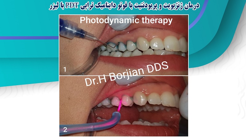 درمان ژنژیویت و پریودنتیت با فوتو داینامیک تراپی PDT با لیز | بهترین دندانپزشک اصفهان