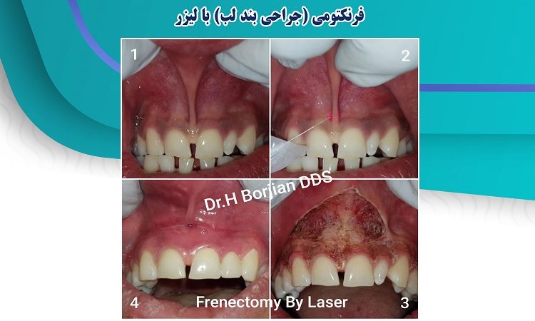 Frenectomy (Lip surgery) with a laser | The best dentist in Isfahan