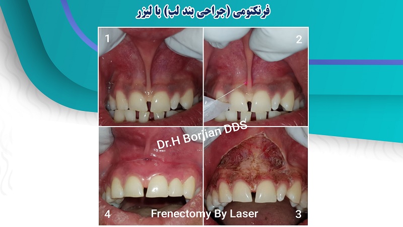فرنکتومی (جراحی بند لب) با لیزر | بهترین دندانپزشک اصفهان