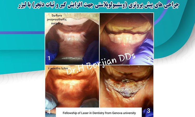 Laser pre-prosthetic surgeries | The best dentist in Isfahan