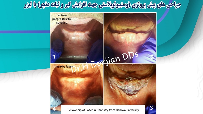 جراحی های پیش پروتزی با لیزر | بهترین دندانپزشک اصفهان