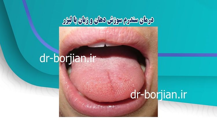 Treatment of mouth and tongue burning syndrome with laser | The best dentist in Isfahan