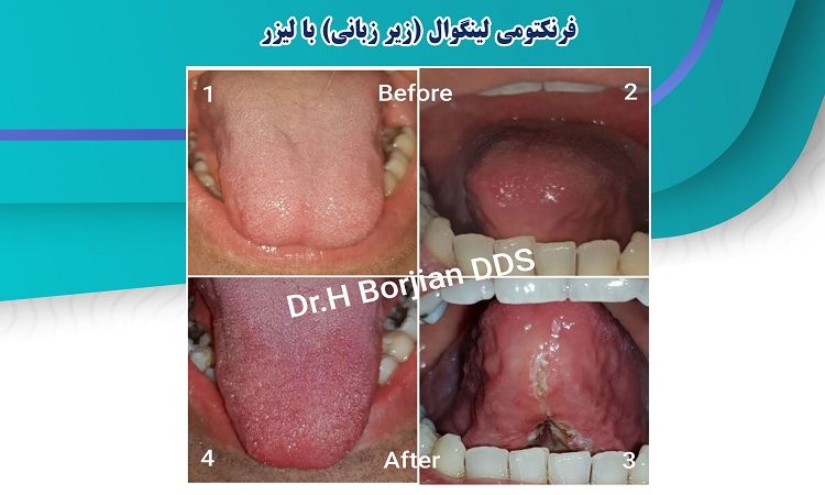 فرنکتومی لینگوال با لیزر | بهترین دندانپزشک اصفهان