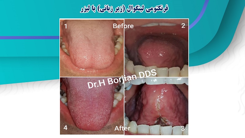 فرنکتومی لینگوال با لیزر | بهترین دندانپزشک اصفهان