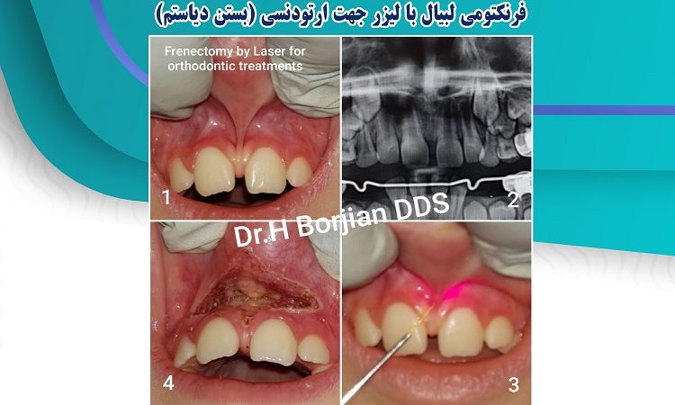 Labial frenectomy with laser for orthodontics | The best dentist in Isfahan