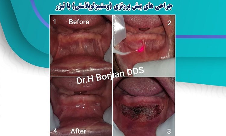 جراحات الليزر التمهيدية | افضل دكتور اسنان في اصفهان