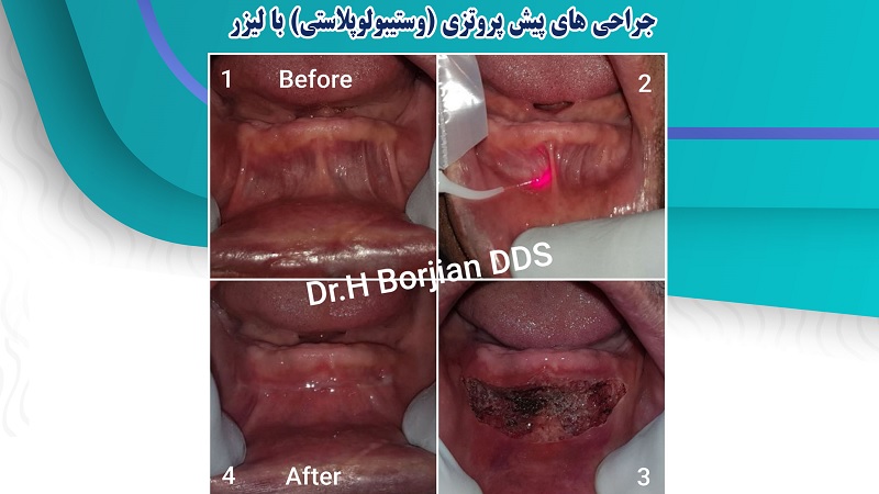 جراحی های پیش پروتزی با لیزر | بهترین دندانپزشک اصفهان