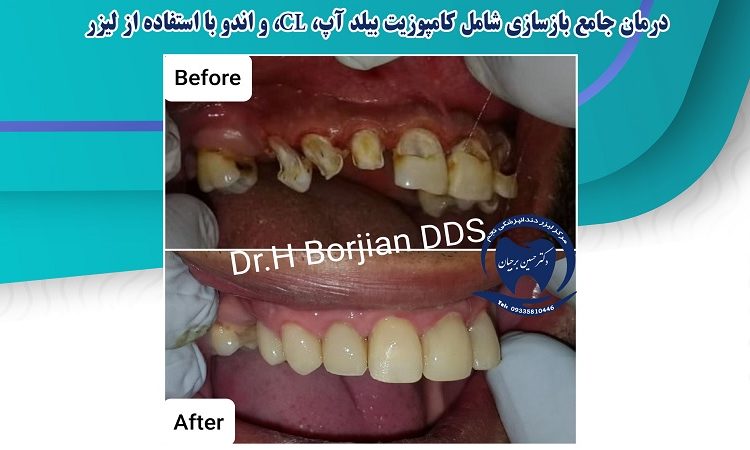 Comprehensive treatment of reconstruction using laser | The best dentist in Isfahan