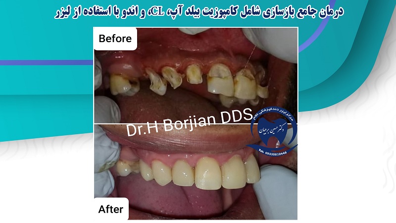 Comprehensive treatment of reconstruction using laser | The best dentist in Isfahan