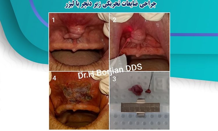جراحة تهيج الآفات تحت أطقم الأسنان بالليزر | افضل دكتور اسنان في اصفهان