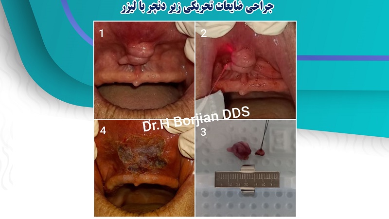 Surgery of irritation lesions under dentures with laser | The best dentist in Isfahan