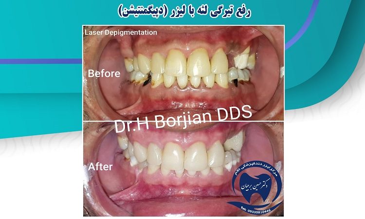 Removal of dark gums with laser (Depigmentation) | The best dentist in Isfahan
