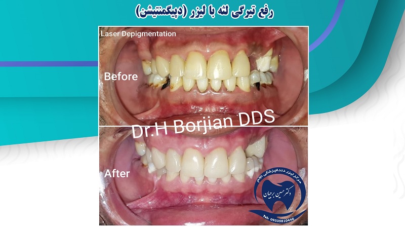 Enlèvement des gencives foncées au laser (Dépigmentation) | Le meilleur dentiste d'Ispahan