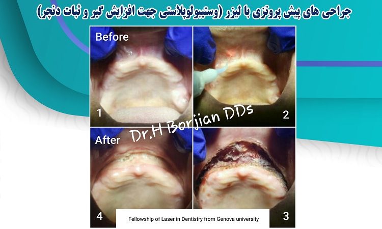 جراحی های پیش پروتزی با لیزر | بهترین دندانپزشک زیبایی اصفهان
