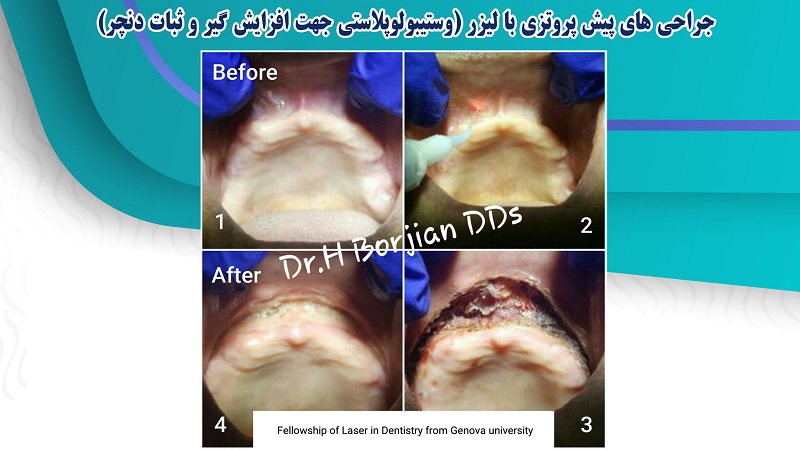 جراحی های پیش پروتزی با لیزر | بهترین دندانپزشک زیبایی اصفهان