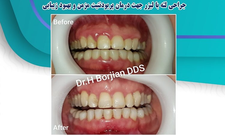 جراحی لثه با لیزر جهت درمان پریودیت مزمن و بهبود زیبایی | افضل دكتور اسنان تجميلي في اصفهان