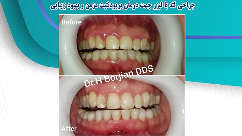 جراحی لثه با لیزر جهت درمان پریودیت مزمن و بهبود زیبایی | افضل دكتور اسنان تجميلي في اصفهان