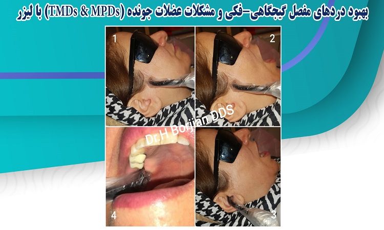 Amélioration des douleurs articulaires temporo-mandibulaires et des problèmes musculaires masticateurs avec le laser | Le meilleur dentiste cosmétique à Ispahan